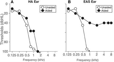 An Individual With Hearing Preservation and Bimodal Hearing Using a Cochlear Implant and Hearing Aids Has Perturbed Sound Localization but Preserved Speech Perception